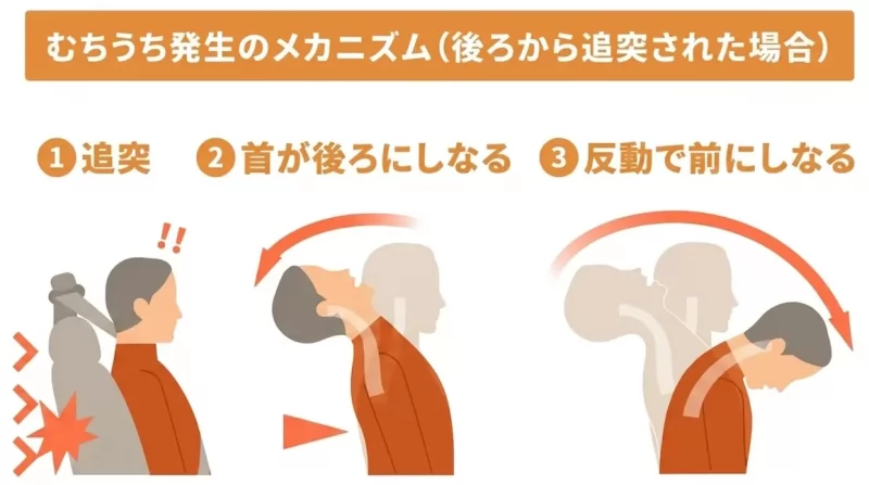 飯田橋接骨院による「むちうちの専門解説」