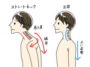 ストレートネック・スマホ首が、肩こりや頭痛、眼精疲労の原因になっているかも。飯田橋接骨院で改善！